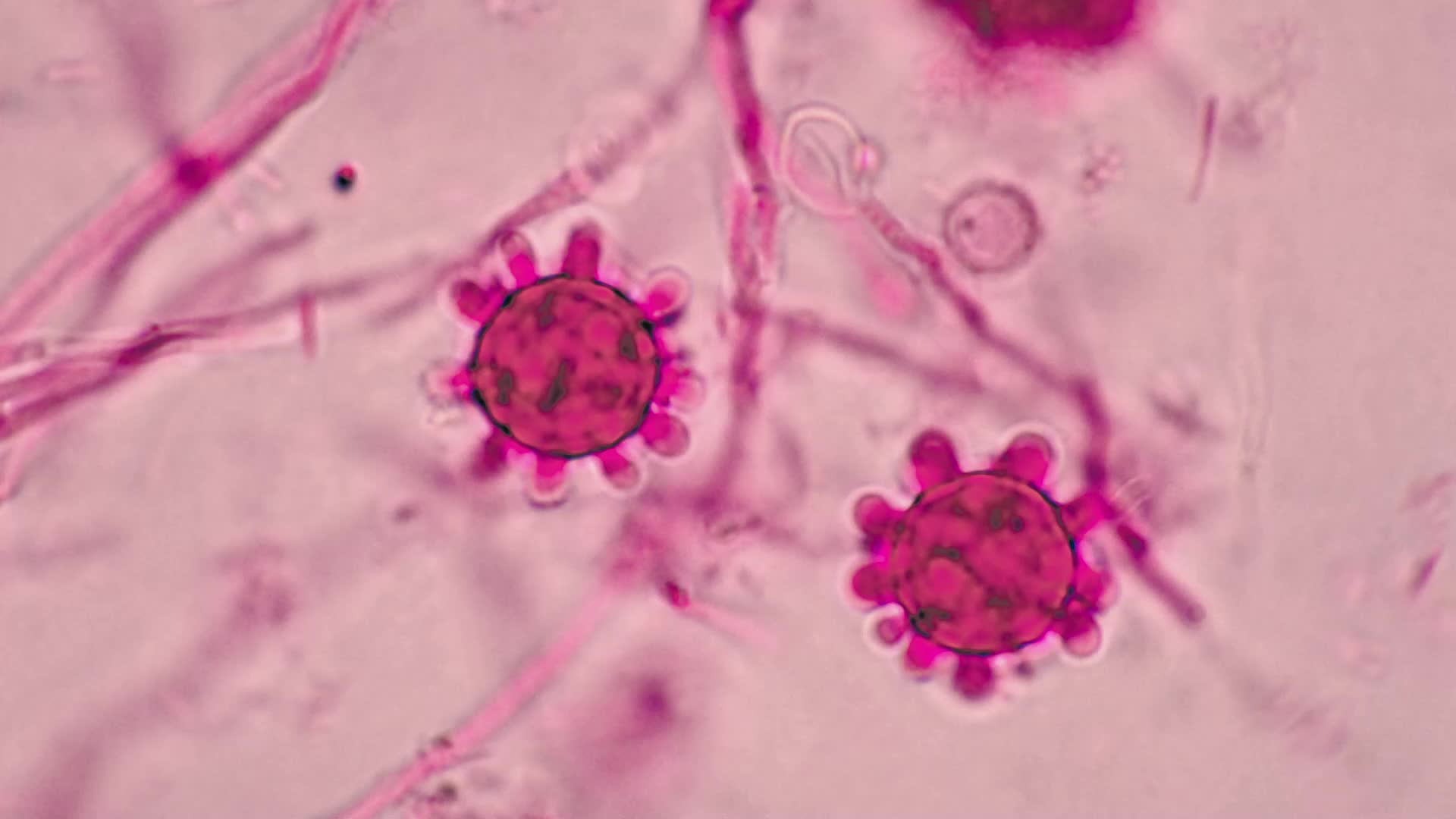 Soil Fungus Lung Infection More Widespread Than Previously Thought