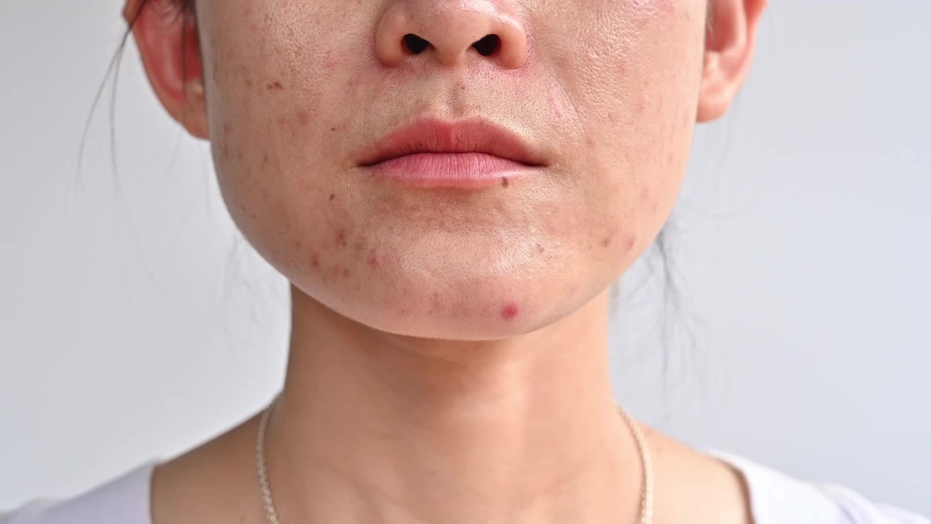 View of Glow Up This Summer With Clearer Skin - Videos from The Weather Channel
