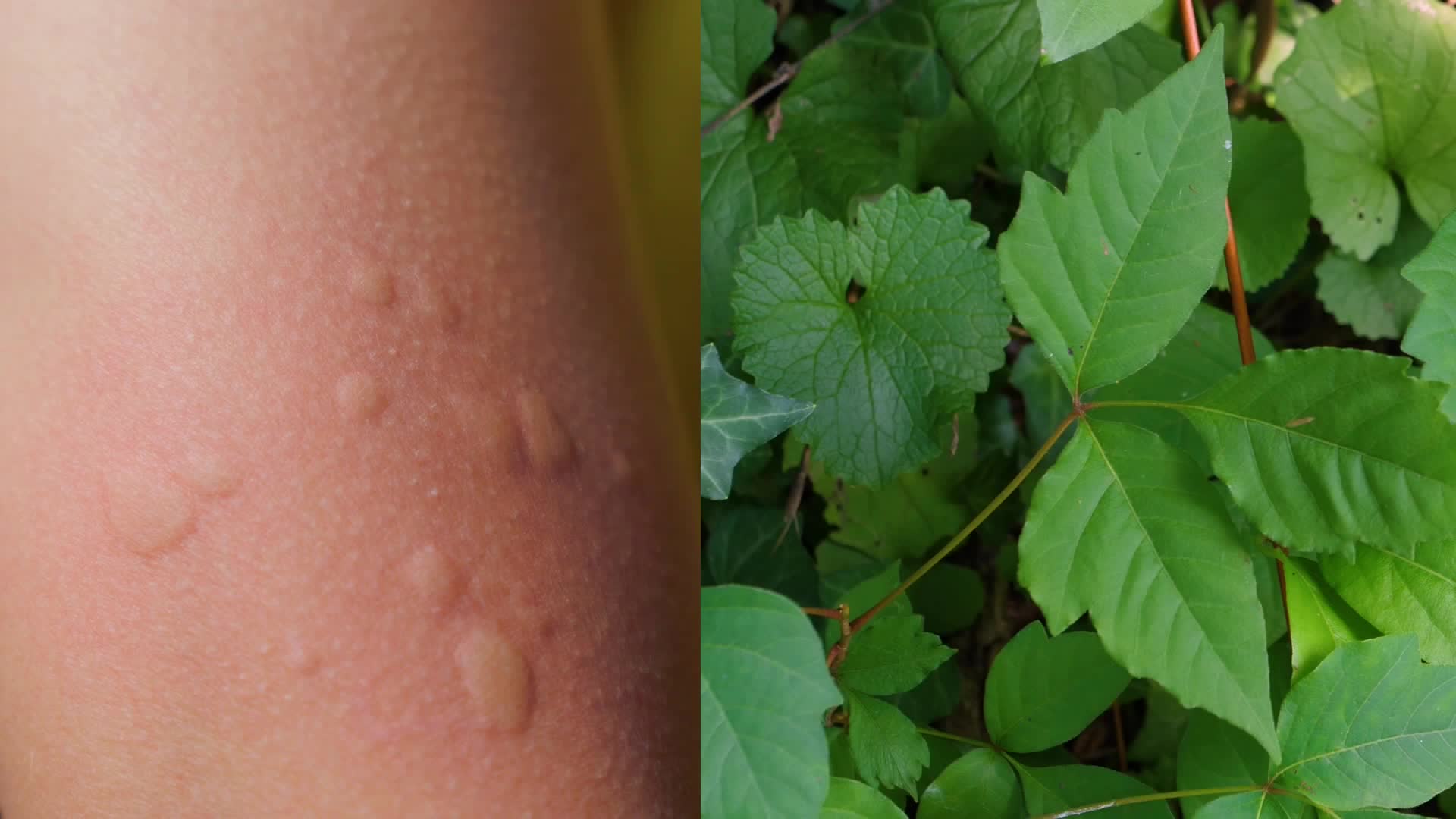 How to soothe poison ivy oak or sumac videos from the weather channel