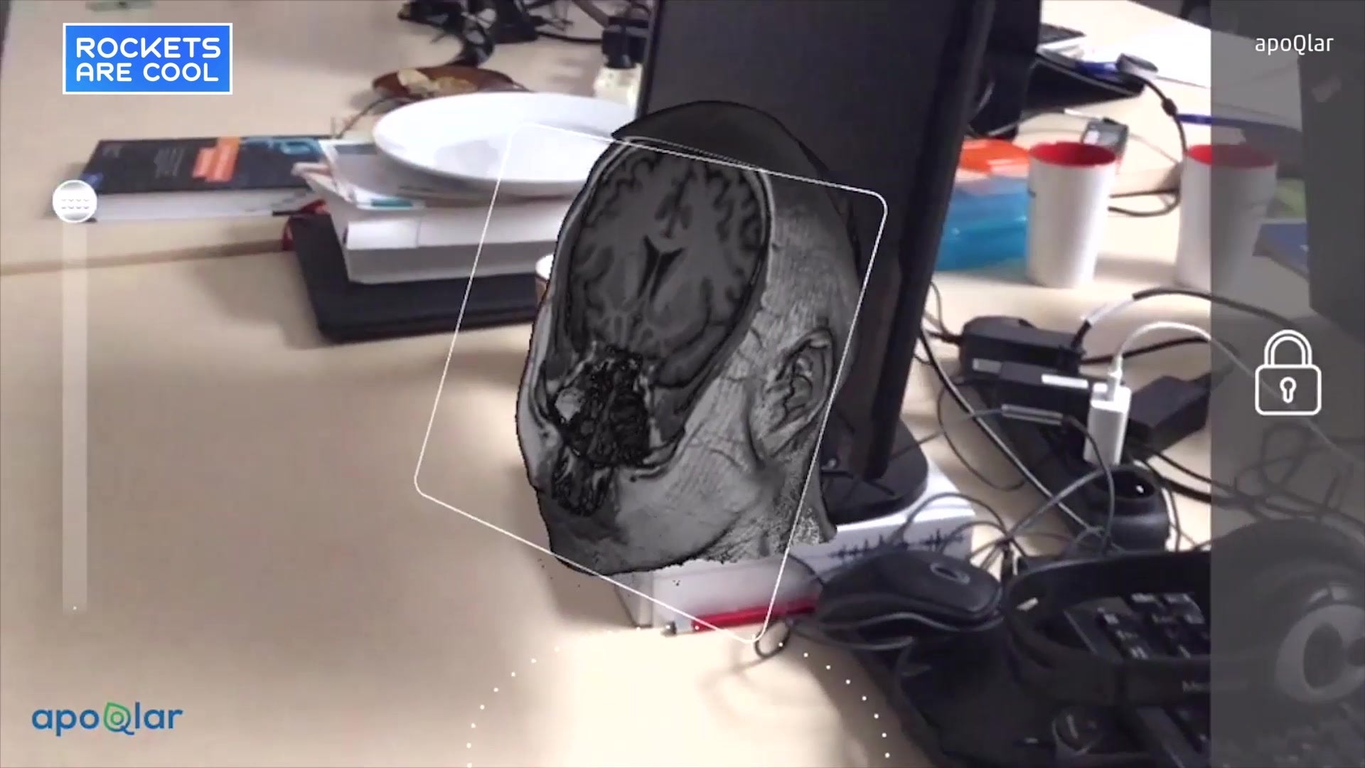 Hololens is New Tool for Surgeons