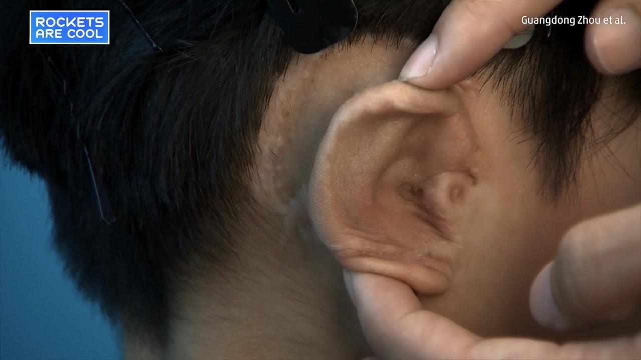 3-D Printed Ears Grown Successfully For Children