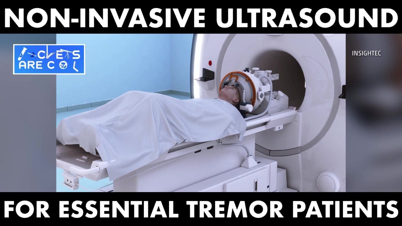 Non-Invasive Treatment Helps Tremor Patients